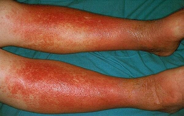 Способы лечения варикозного дерматита нижних конечностей