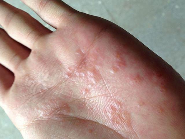 Причины возникновения крапивницы на руках и лечение сыпи
