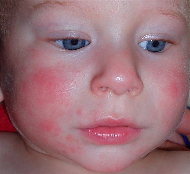 Атопический дерматит у ребёнка: диета, меню гипоаллергенного питания