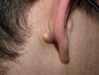 Жировик за ухом: причины появления и способы лечения липомы