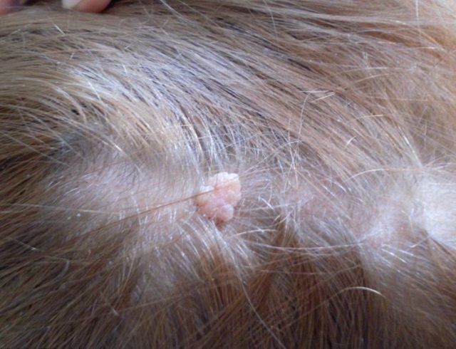 Причины образования и удаление папилломы в волосистой части головы