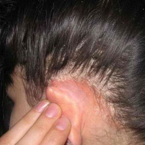 Средства для лечения экземы на голове в волосах