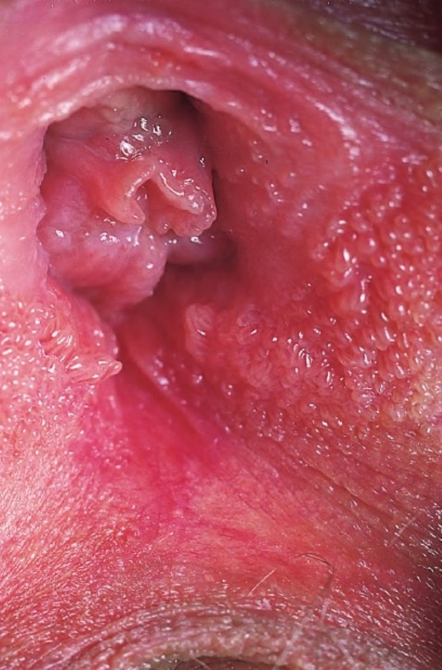 Лечение остроконечных кондилом во влагалище и внутри матки