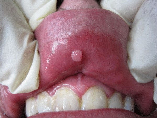 Папилломы во рту: причины появления ВПЧ и как лечить папилломатоз