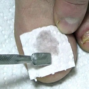 Лечение грибка ногтей уксусом в домашних условиях