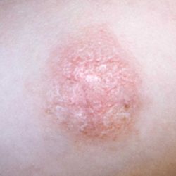 Симптомы дерматозов: как выглядит псориаз в начальной стадии