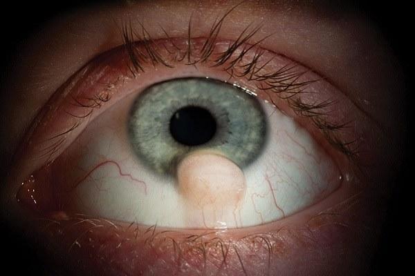 Нарост на глазу: причины и лечение образования на глазном яблоке