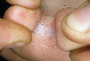 Чем лечить грибок на ногах между пальцами в домашних условиях