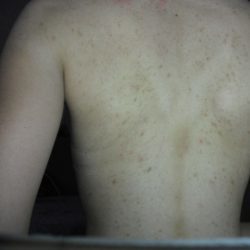 Прыщи на плечах: причины появления и лечение акне