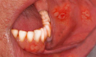 Причины, симптомы и лечение герпеса во рту и на губах у взрослых