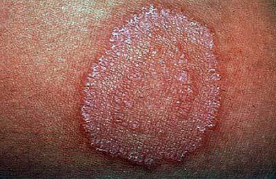 Паховый дерматит: причины появления, симптомы и особенности лечения