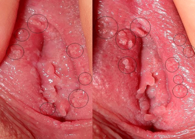 Причины и лечение прыщей на половых губах у женщин