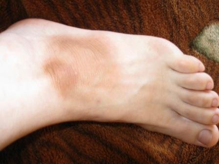 Причины появления и способы лечения коричневых пятен на коже ног