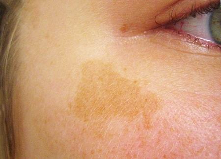 Родимое пятно на лице: как можно вывести новообразование