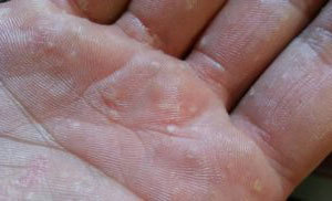 Причины и лечение водяных прыщиков на руках, ладонях, пальцах
