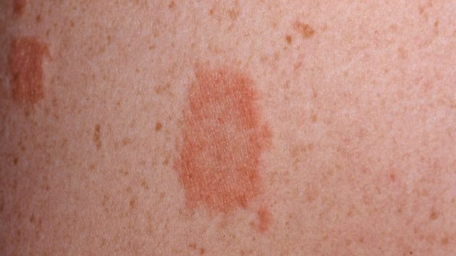 Цветной лишай на коже: причины, симптомы и лечение в домашних условиях
