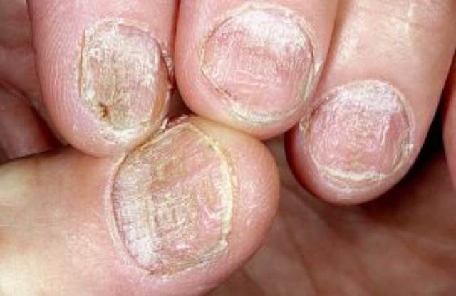 Причины и лечение псориаза ногтей на ногах и руках