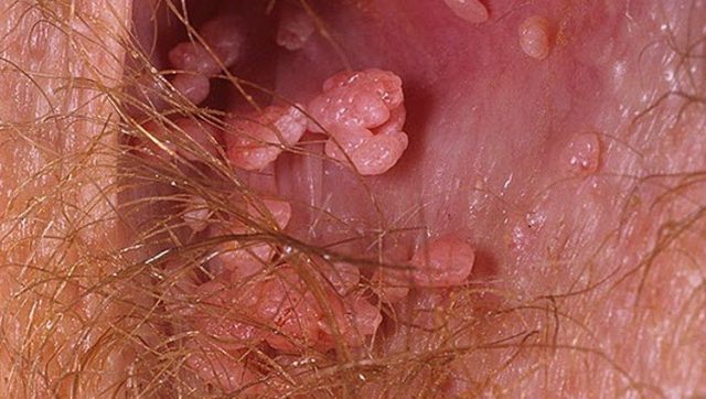 Бородавки на половых губах: причины и лечение наростов на гениталиях