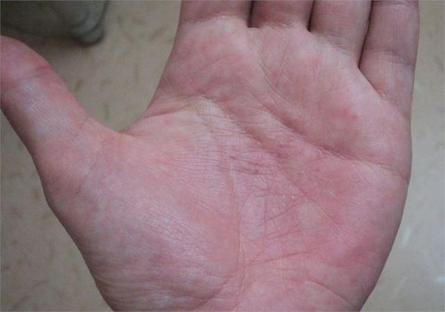 Причины возникновения крапивницы на руках и лечение сыпи