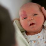Родимые пятна у новорожденных: виды и причины появления