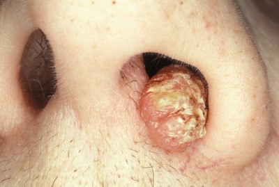 Причины возникновения папилломы в носу и её лечение и удаление