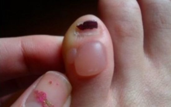 Нарост на пальце ноги: причины появления и особенности лечения