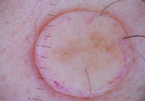 Папилломатозный внутридермальный меланоцитарный невус кожи