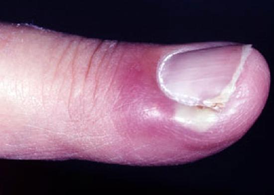 Грибок на пальцах рук: причины, симптомы и лечение