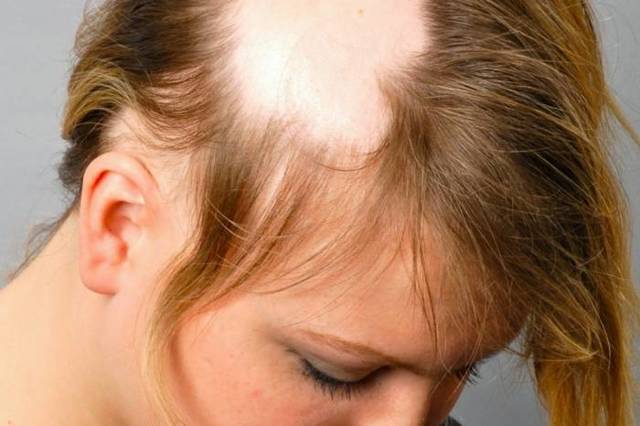 Грибок кожи головы: причины, симптомы и лечение