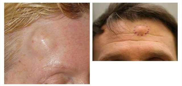 Разновидности и способы лечения наростов на коже человека