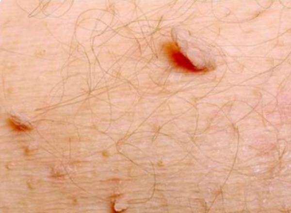 От чего появляются папилломы на коже и способы лечения впч