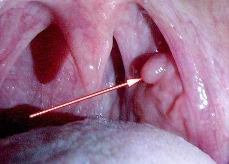 Признаки и причины папилломы в горле и лечение от заболевания