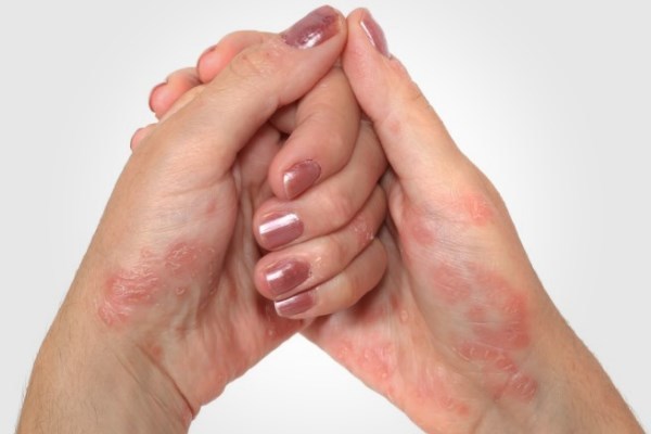 Как вылечить псориаз на руках и надолго избавиться от его симптомов