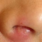 Фурункул на носу: причины, симптомы и особенности лечения