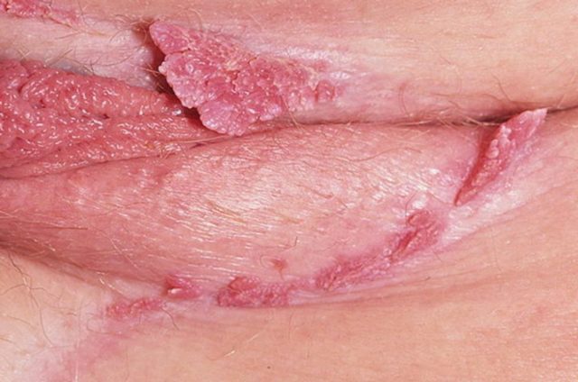Лечение остроконечных кондилом на половых губах у женщин