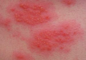 Причины, симптомы и лечение аллергического дерматита