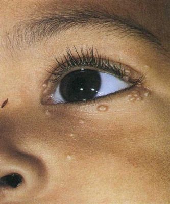 Причины и лечение папилломы на слизистой глаза разными методами