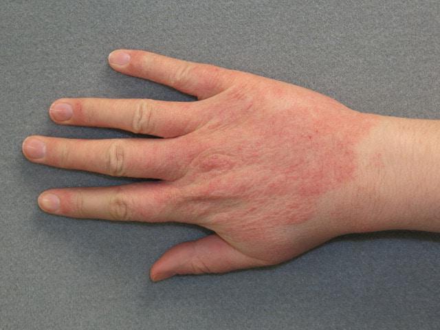 Лечение дерматита на руках мазями и кремами