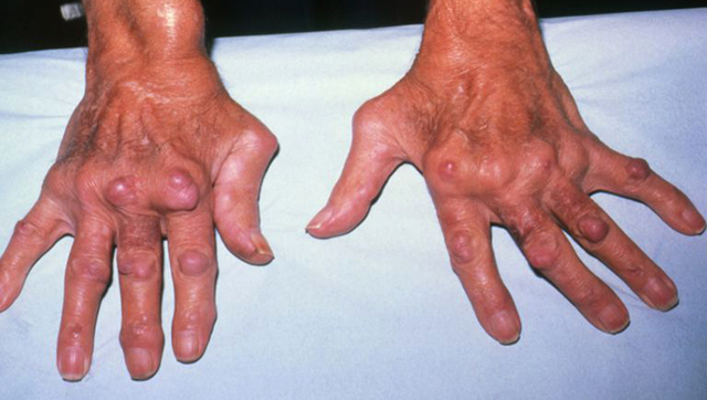 Твердый нарост на пальце руки: причины, симптомы, лечение