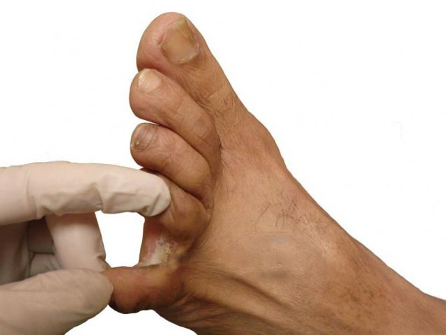 Как вылечить мозоль, которая образовалась между пальцами на ноге