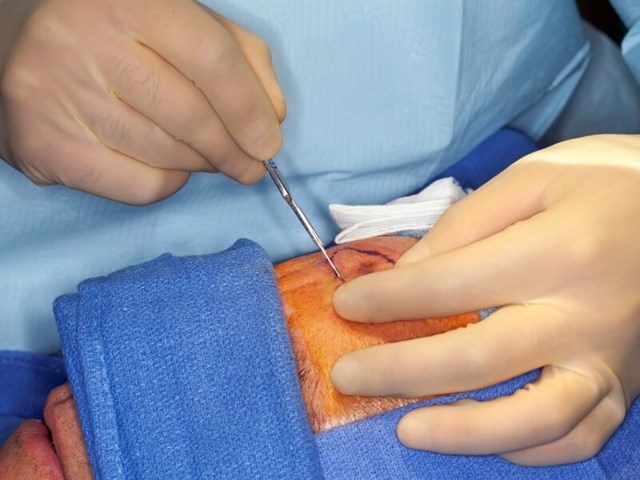 Способы хирургического удаления невусов и последствия операций