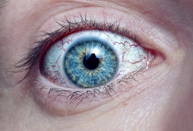 Герпес в глазу: симптомы инфекции и лечение