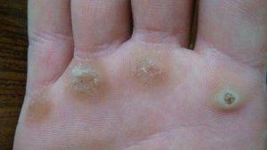 Причины и методы удаления шипицы на пальце руки