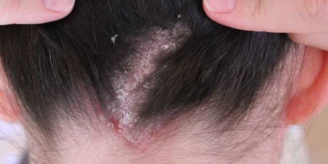 Как лечить себорейный дерматит на волосистой части головы