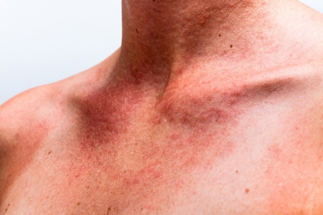 Пигментные пятна и причины их появления на шее, лечение