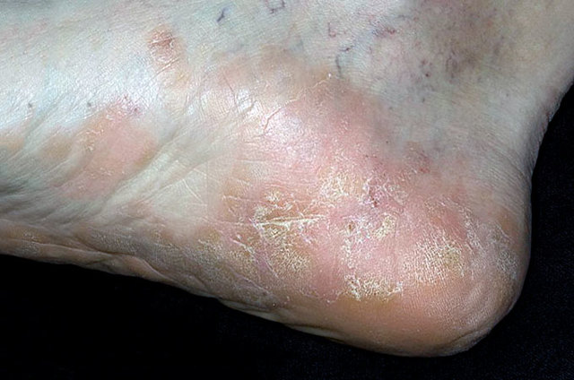 Как лечить псориаз на пальцах ног, стопе и голени