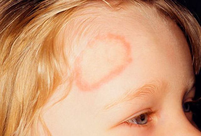 Лечение стригущего лишая на голове у ребенка