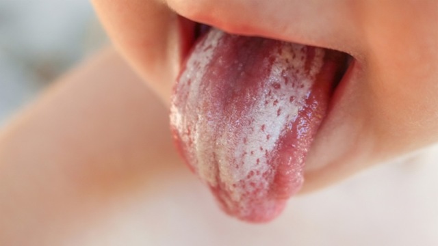 Основные симптомы и лечение грибка в полости рта и горла