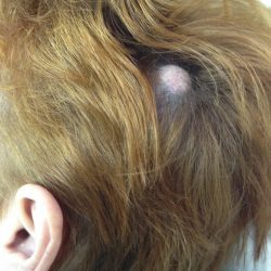 Удаление атеромы (жировика) на волосистой части головы