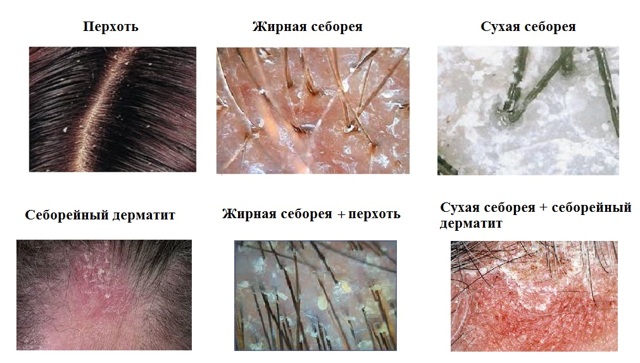 Методы лечения себореи кожи головы в домашних условиях